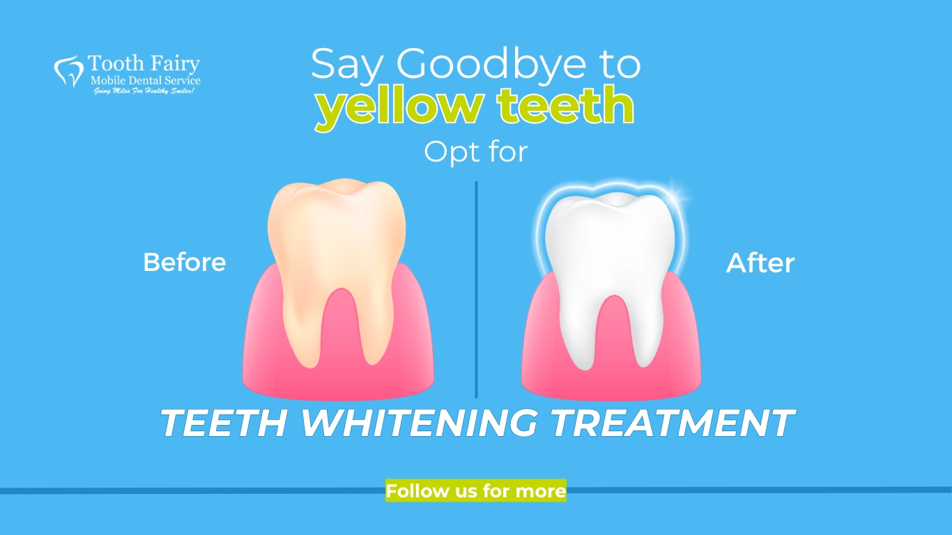 Tooth_Teeth Whitening